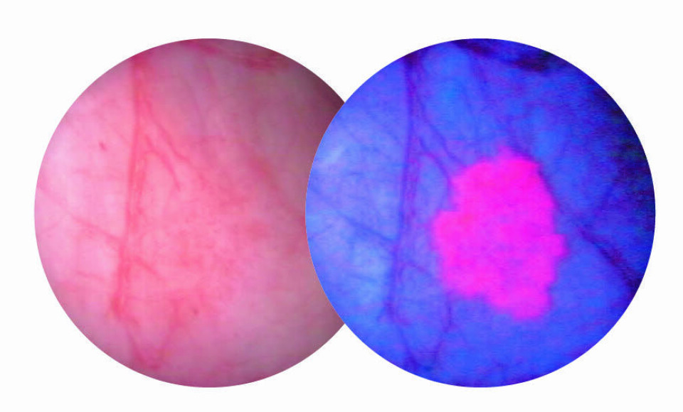 Illustrasjonen viser forskjellen mellom tradisjonell cytoskopi med hvitt lys og Photocures blålyscytoskopi (til høyre). Illustrasjon: Photocure Foto: