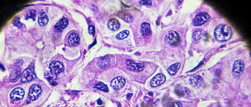 Hepatocellulært karsinom sett under mikroskop. Illustrasjon: Getty Images Foto:
