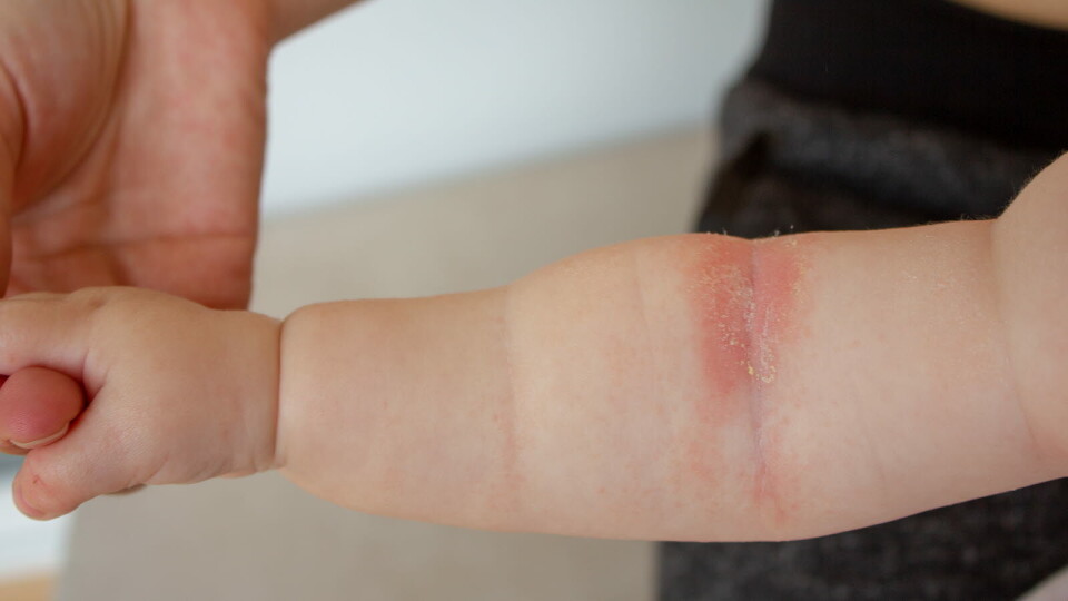 Amerikanske legemiddellmynbdigheter har godkjent dupilumab (Dupixent) for bruk hos barn ned til seks måneders alder. Illustrasjonsbilde: Getty Images Foto: