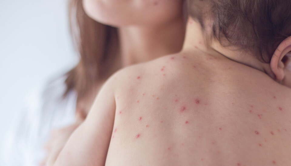 SPORER SMITTE: Sandnes kommune er i gang med smittesporing etter at en person er bekreftet smittet med meslinger. Illustrasjonsfoto: Getty Images