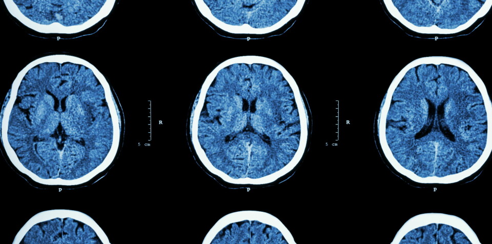 SATSING: Dersom man skal klare å behandle pasienter med hjernesykdom i framtiden er det viktig å satse på forskning på feltet, og forskningen må omsettes i praksis, sier lederen i Norsk nevrologisk forening. Illustrasjonsfoto: Colourbox Foto: