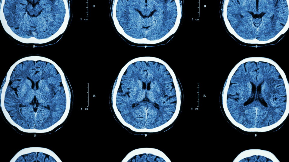 OVERVÅKE: Norsk kvalitetsregister for alvorlige primære hodepiner skal overvåke om pasienter blir diagnostisert og behandlet i henhold til gjeldende retningslinjer og følge opp resultatet av behandlingen. Illustrasjonsfoto: Colourbox Foto: