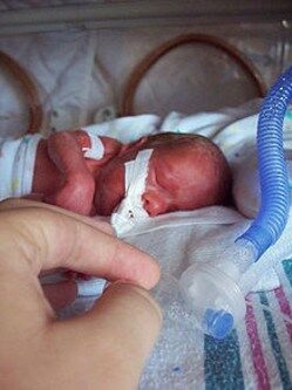 FOR TIDLIG FØDT: 24 timer gammelt prematurt barn født ved gestasjonsalder 27 uker med fødselsvekt 990 gram. Barnet deltok i studien og bildet er gjengitt med tillatelse
Foto: Privat
