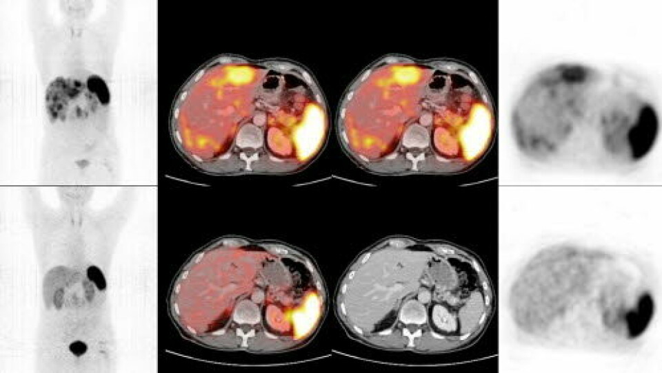 FØR OG ETTER: Den øverste rekken viser PET/CT bilde av pasient før behandlingen med det radioaktive legemiddelet. Den nederste rekken viser samme pasient etter behandling, med nærmest komplett remisjon av levermetastaser. Foto: Haukeland universitetssjukehus