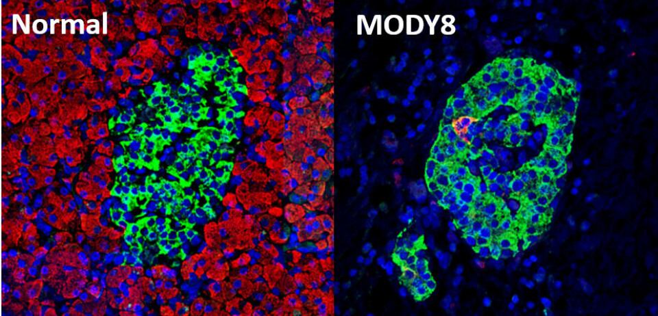 MUTASJON: I bukspyttkjertelen er de insulinproduserende cellene (grønne) vanligvis omgitt av celler som produserer fordøyelsesenzymet CEL (røde). I sykdommen MODY8 er de røde cellene blitt ødelagt. I stedet kan CEL påvises i noen av de grønne cellene.

 Foto: Jahedul Alam