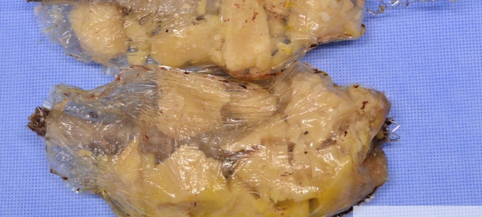 Implantat-skandalen: NPE betaler ut erstatning til pårørende