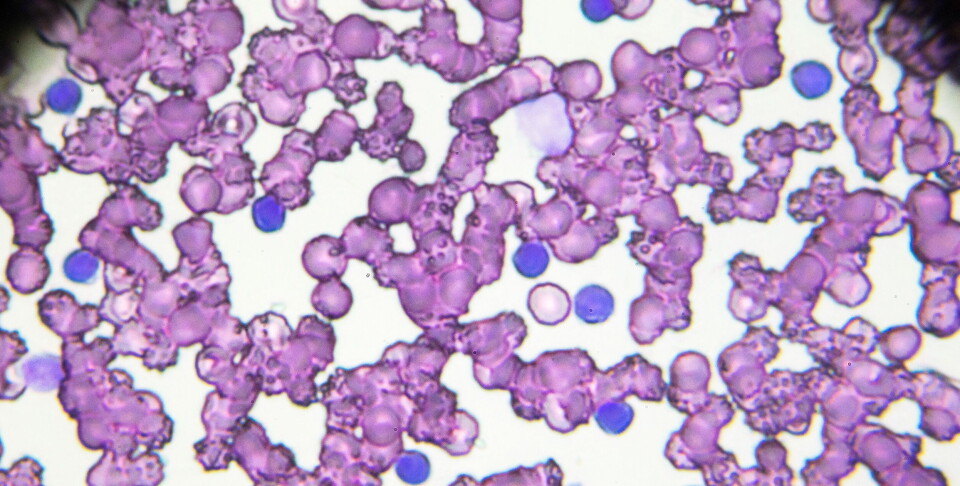 Kombinasjonsbehandlingen med ibrutinib og rituksimab demonstrerte overlegen progresjonsfri overlevelse sammenlignet med kjemoterapi i pasienter med kronisk lymfatisk leukemi (bildet). Illustrasjon:Getty Images Foto: