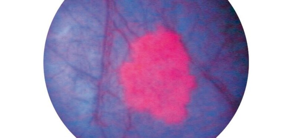 FLAGGSKIP: Heksaminolevulinat Hexvix er flaggskipproduktet til norske Photocure, og brukes til å diagnostisere blærekreft. Foto: Photocure