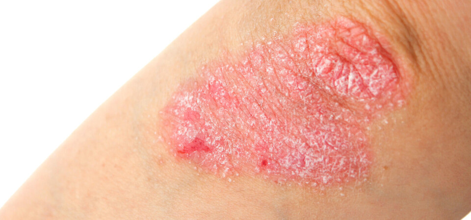 TNF-HEMMER: Etanercept er et legemiddel i klassen TNF-hemmere, som brukes i behandlingen av blant annet psoriasis (bildet) og leddsykdommer. Foto: Thinkstock