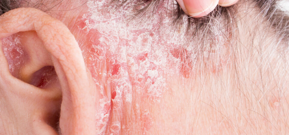 MOT PSORIASIS: Adalimumab brukes blant annet i behandlingen av hudsykdommen psoriasis. Foto: Thinkstock