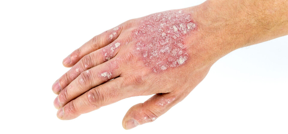 PSORIASIS: Danske LEO Pharma spesialiserer seg på psoriasis og andre hudsykdommer. Foto: Thinkstock