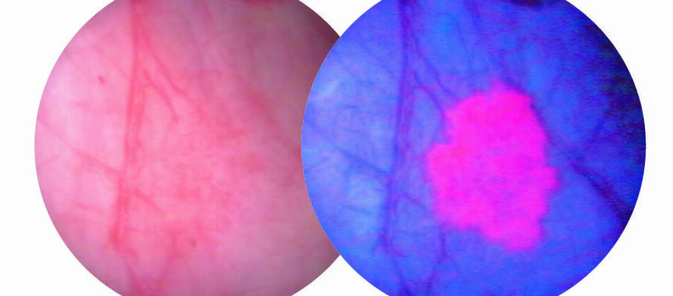 Illustrasjonen viser resultat fra tradisjonell cytoskopi med hvitt lys (t.v) og blålyscytoskopi med diagnostikumet heksaminolevulinat. Illustrasjon: Photocure Foto: