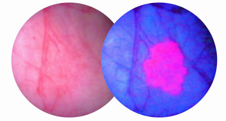 Illustrasjonen viser forskjellene mellom cytoskopi med hvitt lys og blålyscytoskopi med det diagnostiske legemiddelet heksaminolevulinat. Foto: Photocure