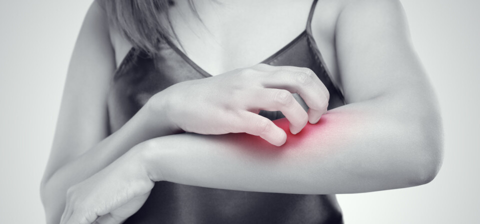 Atopisk dermatitt er en kronisk inflammatorisk sykdom hvor de vanligste symptomene er utslett på huden. Foto: Thinkstock