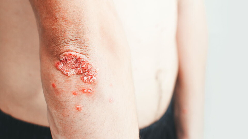FREMSKRITT: – Dette representerer et viktig steg fremover for over 100 millioner mennesker som lever med psoriasis verden rundt. Mange av disse er underbehandlede og trenger nye og effektive orale terapier, sier Bruce Strober, klinisk professor i dermatologi ved universitetet i Yale. Illustrasjon: Getty Images Foto: