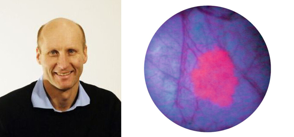 FORNØYD: Direktør i Photocure, Kjetil Hestdal, er fornøyd med vekst i markedet. Montasje med kikkhullsbilde av hexaminolevulinate (Hexvix) som opplyser en blærekreftssvulst. Foto: Privat / Photocure