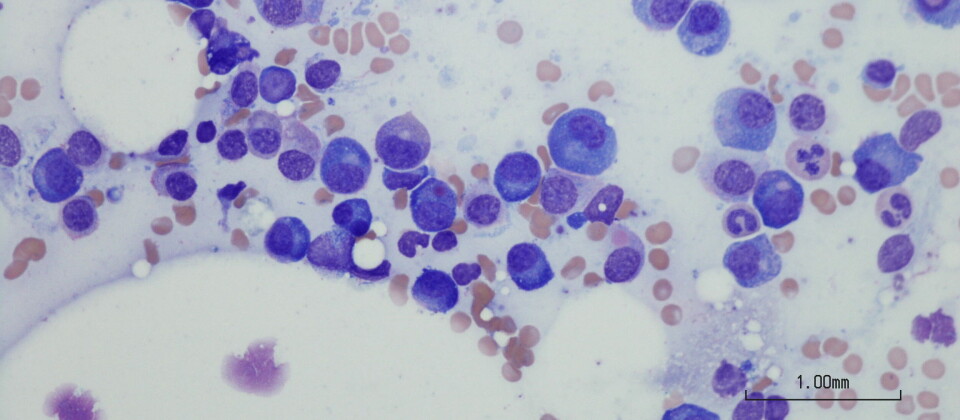Illustrasjonen viser myelomatose i benmargen sett under mikroskop. Illustrasjon: Getty Images Foto: