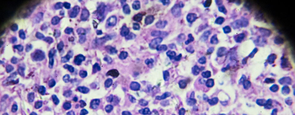 Bildet viser non-Hodgkins lymfom under mikroskop. Illustrasjon: Getty Images Foto: