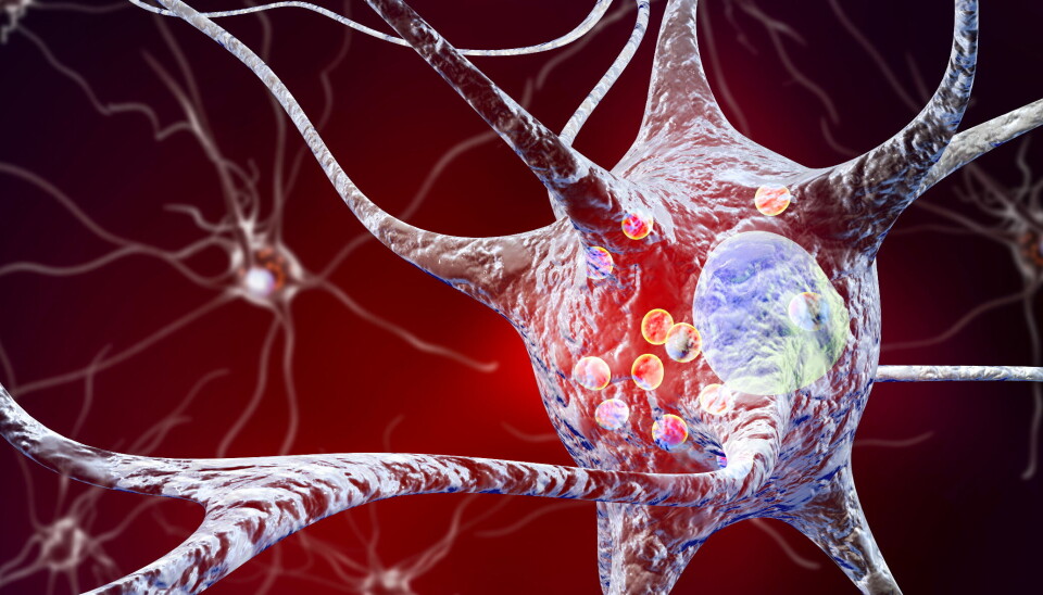 STAMCELLETERAPI: Parkinsons skyldes en gradvis ødeleggelse av nerveceller som skiller ut stoffet dopamin. Forskere har utviklet et stamcelle-produkt som etter transplantasjon, skal modnes til funksjonelle nerveceller som produserer dopamin. Illustrasjonsfoto: Getty Images STAMCELLETERAPI: Parkinsons skyldes en gradvis ødeleggelse av nerveceller som skiller ut stoffet dopamin. Forskere har utviklet et stamcelle-produkt som etter transplantasjon, skal modnes til funksjonelle nerveceller som produserer dopamin. Illustrasjonsfoto: Getty Images