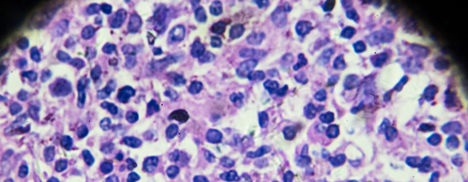 Bildet viser non-Hodgkins lymfom sett under mikroskop. Foto: Getty Images