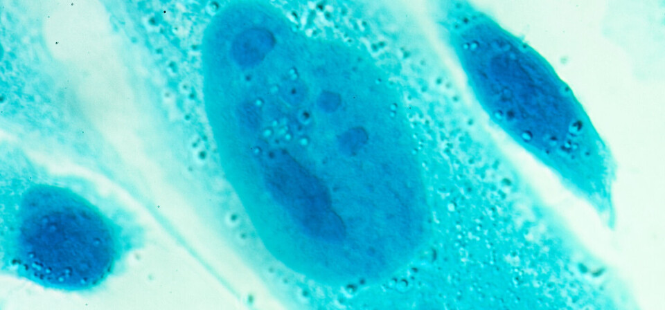 RAMMER MANGE: Prostatakreft rammer rundt 47.000 briter årlig. Heretter vil en større andel av disse få tilbud om norskutviklede Xofigo, melder den britiske legemiddelmyndigheten. Foto: Thinkstock