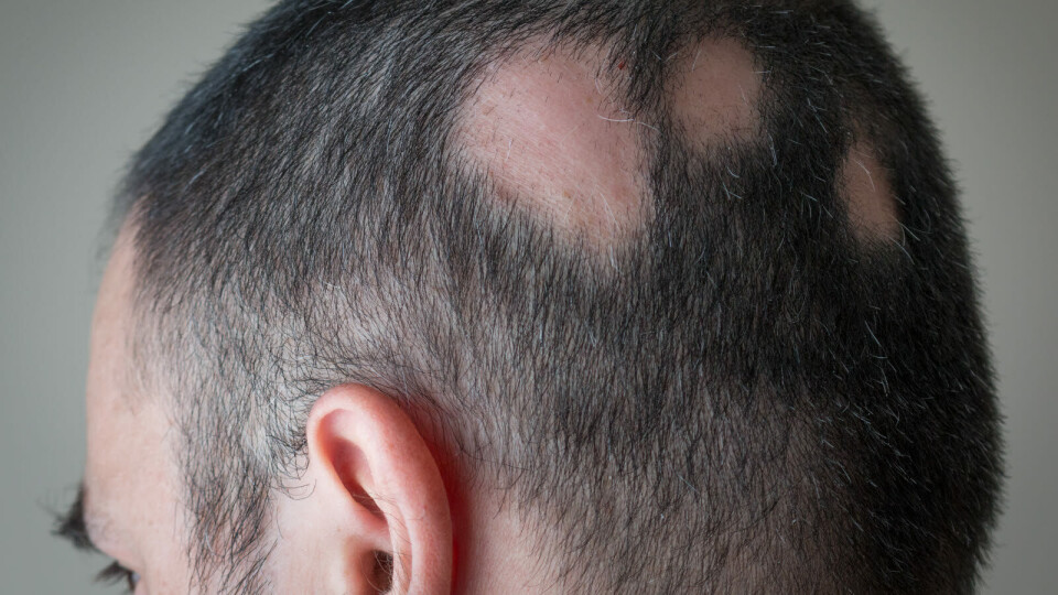 KAN BLI FØRST: – Dette kan bli den første godkjente behandlingen for personer som lever med alopecia areata, sier Lotus Mallbris, direktør for immunologisk utvikling i Eli Lilly. Illustrasjon: Getty Images Foto: