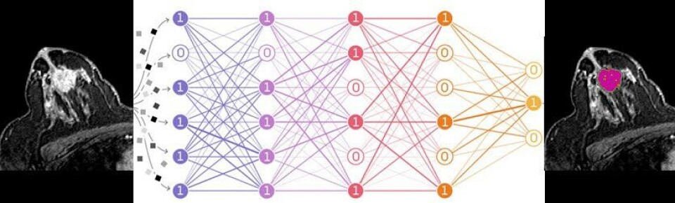 KUNSTIG INTELLIGENS: Illustrasjonen viser hvordan et MR bilde blir tolket av en KI-modell som automatisk finner og markerer hvor brystkreftsvulsten er. Foto: Endre Grøvik KUNSTIG INTELLIGENS: Illustrasjonen viser hvordan et MR bilde blir tolket av en KI-modell som automatisk finner og markerer hvor brystkreftsvulsten er. Foto: Endre Grøvik