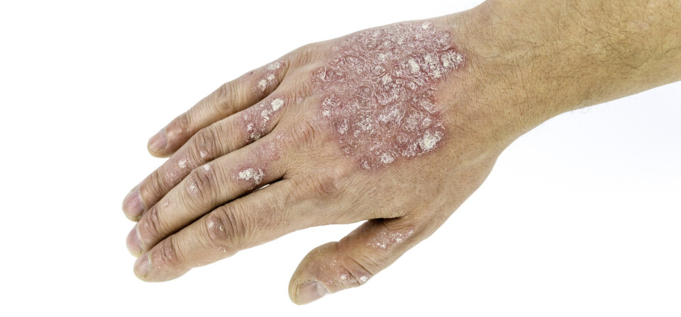 Personer med fedme hadde 87 prosent økt risiko for å utvikle psoriasis sammenlignet med normalvektige, ifølge studien. Foto: Thinkstock