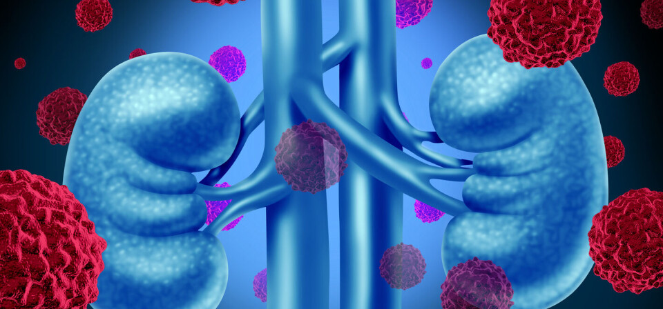 NYREKREFT: Immunterapi for avansert eller metastatisk nyrekreft har frem til nå vært ansett for kostbart, i forhold til nytten, til at den kunne tas i bruk i Norge. Illustrasjon: ThinkStock Foto: NYREKREFT: Immunterapi for avansert eller metastatisk nyrekreft har frem til nå vært ansett for kostbart, i forhold til nytten, til at den kunne tas i bruk i Norge. Illustrasjon: ThinkStock Foto: