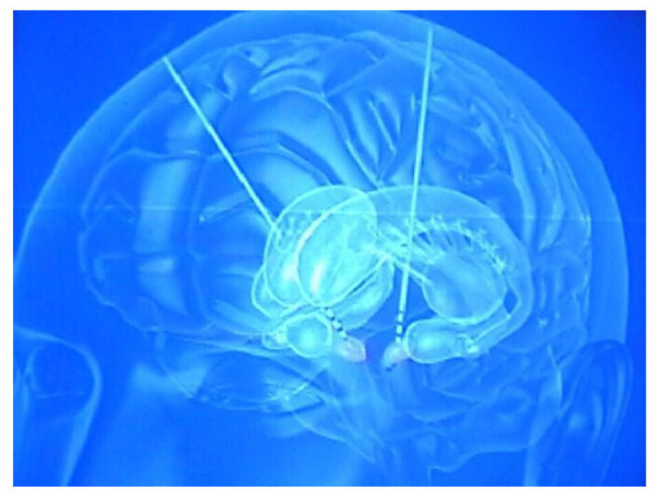 Underbehandling av pasienter med Parkinsons