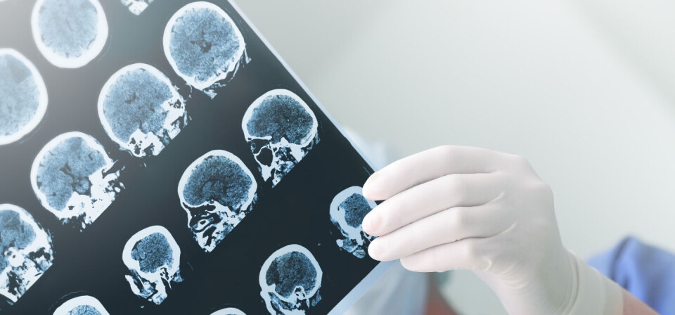 IKKE KLINISK EFFEKT: Forskerne fant ikke positive endringer på en skala som måler kognisjon. Illustrasjonsfoto: ThinkStock Foto:
