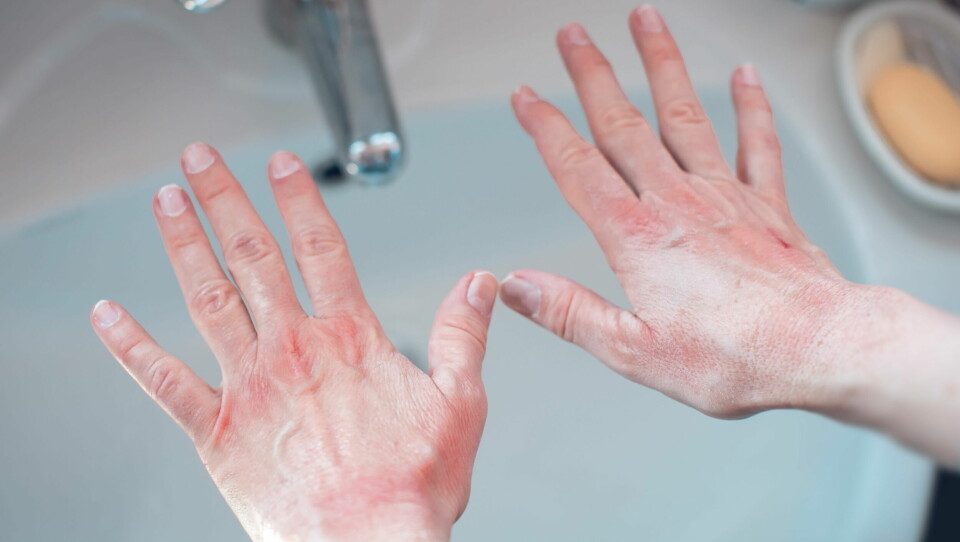 MER PLAGER: Studien viste signifikant sammenheng mellom økt hyppighet av håndvask, bruk av hånddesinfeksjon og hansker og økte symptomer fra hender, håndledd og underarmer. Foto: Getty Images Foto: