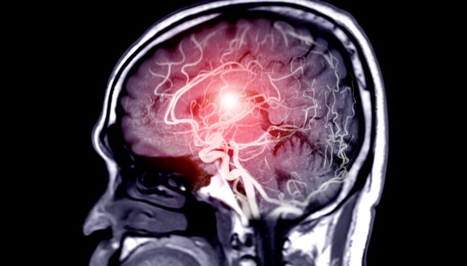 RAMMER SYNET: Store deler av hjernen er involvert i synsfunksjonen. Redusert skarpsyn er det vanligste synsproblemet etter slag, men mange opplever også dobbeltsyn, synsfeltutfall og problemer med tolkning av synsinformasjon. Illustrasjonsfoto: Getty Images