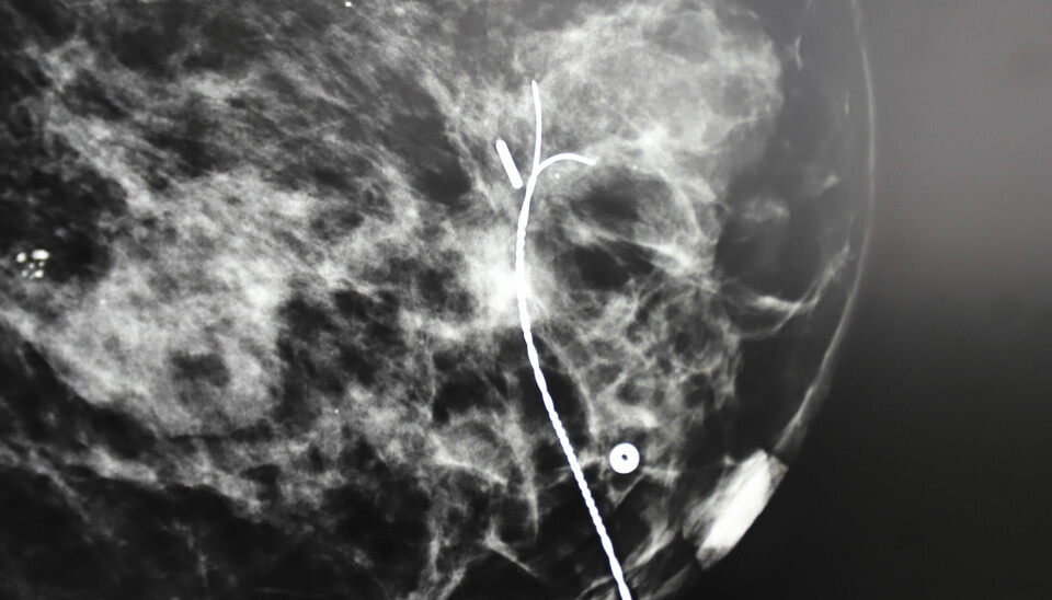 Røntgenbildet viser både det lille jodkornet og metalltråden som kornet på sikt skal erstatte.