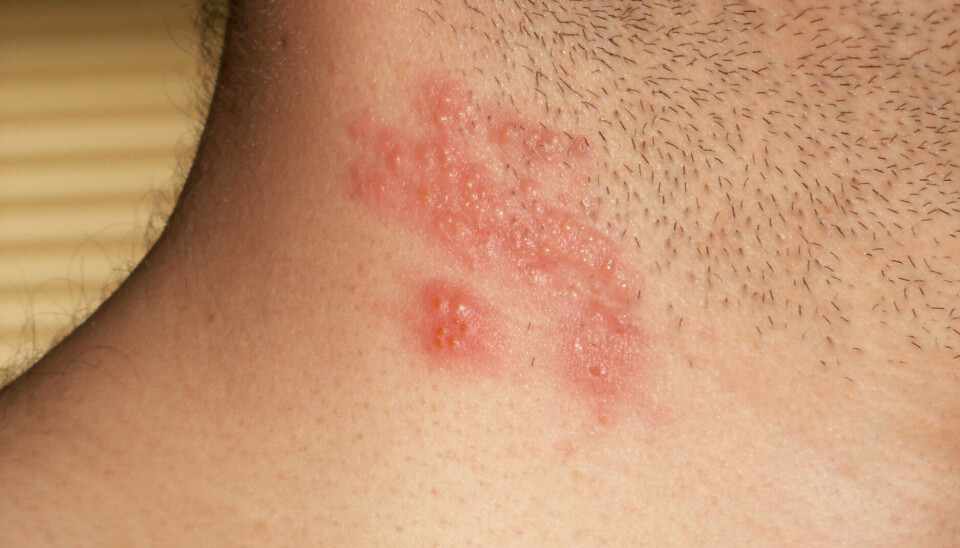 Helvetesild også kalt herpes zoster, forårsakes av det samme virus som vannkopper, varicella zoster-viruset.