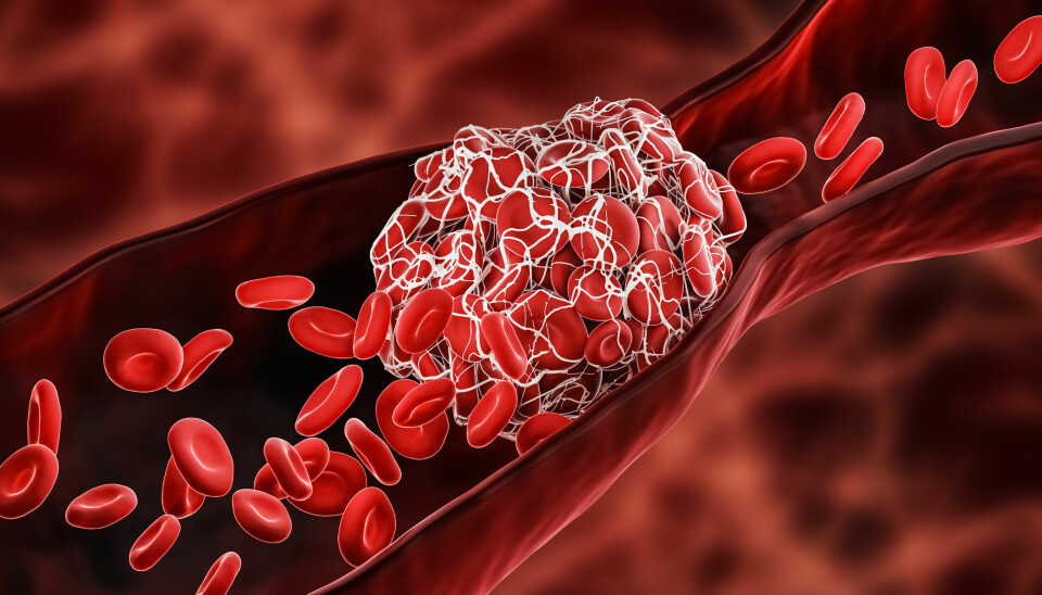 BIOMARKØR: Etter å ha analysert over 400 proteiner i blodet til pasienter med mistenkt blodpropp, fant forskerne at proteinet CFHR5 var tydelig forhøyet hos dem som hadde blodpropp. Nå håper de proteinet kan brukes som en biomarkør, slik at diagnosen kan stilles med blodprøve. Illustrasjonsfoto: Getty Images