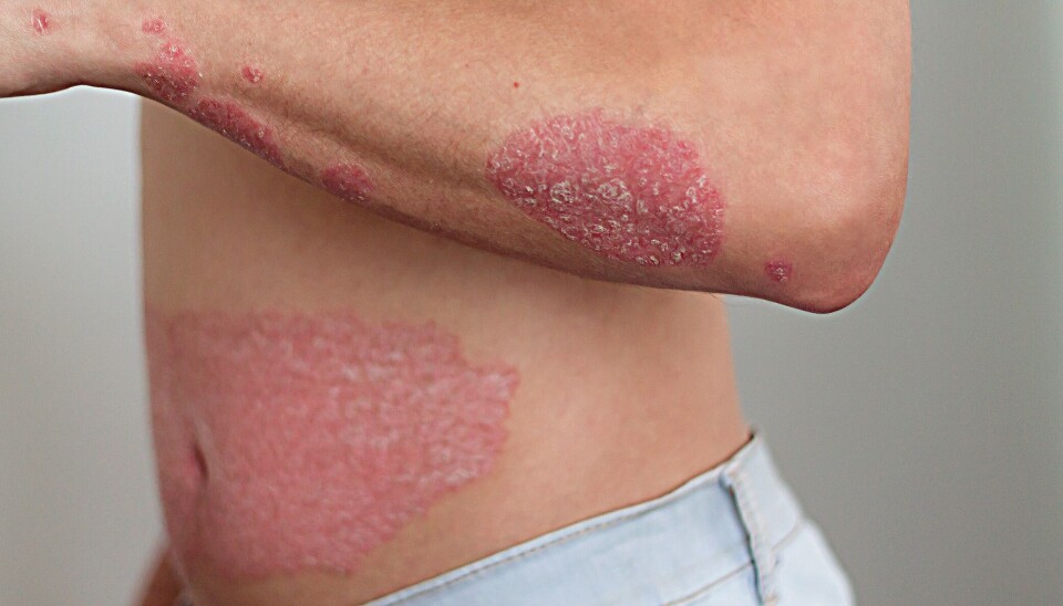 PSORIASIS: Målrettet behandling med interleukin-23-hemmer