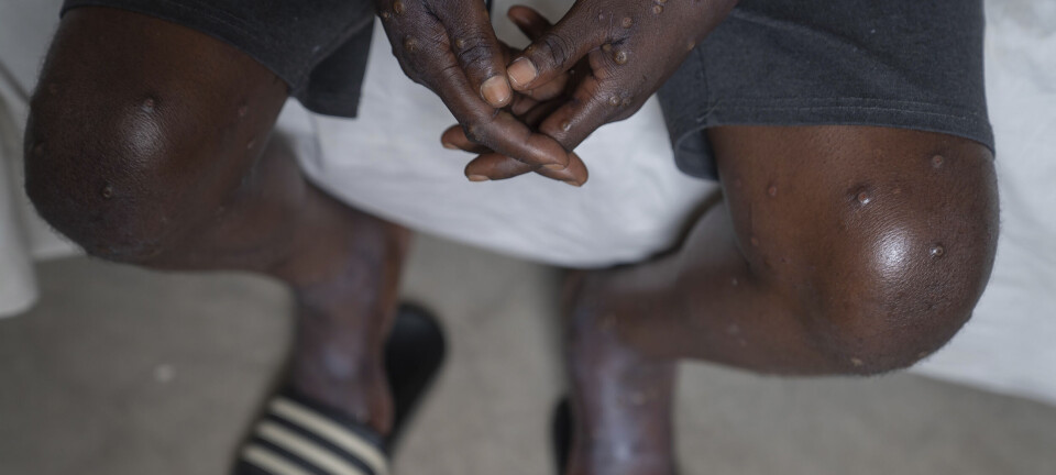 Dansk selskap vil produsere mpox-vaksine for tenåringer