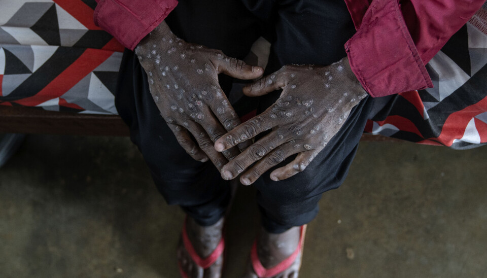 PÅ PLASS: En person med m-kopper venter på behandling på et sykehus i Kongo 4. september. De første leveransene av vaksiner mot sykdommen er omsider på plass i Kinshasa.