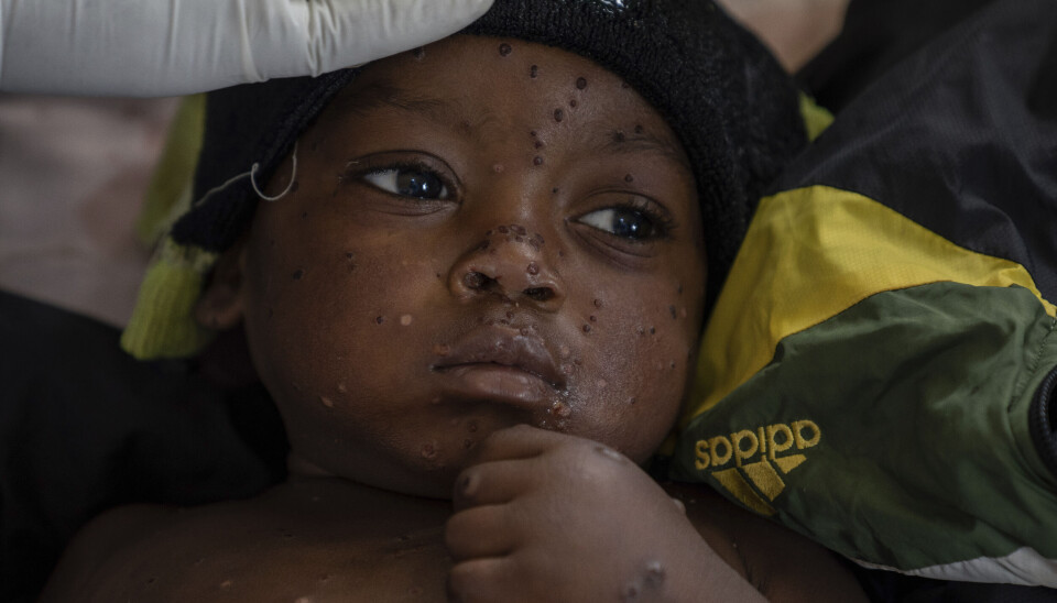Emile Miango, 2 år, som har mpox, ligger på sykehuset onsdag 4. september 2024 i Kamituga, Sør-Kivu-provinsen, som er episenteret for verdens nyeste utbrudd av sykdommen i østlige Kongo. (AP-foto/Moses Sawasawa)